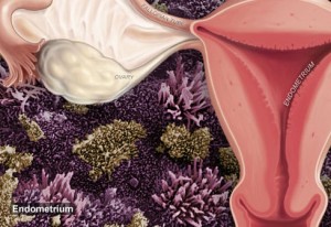 endometriosis_illustration-300x206
