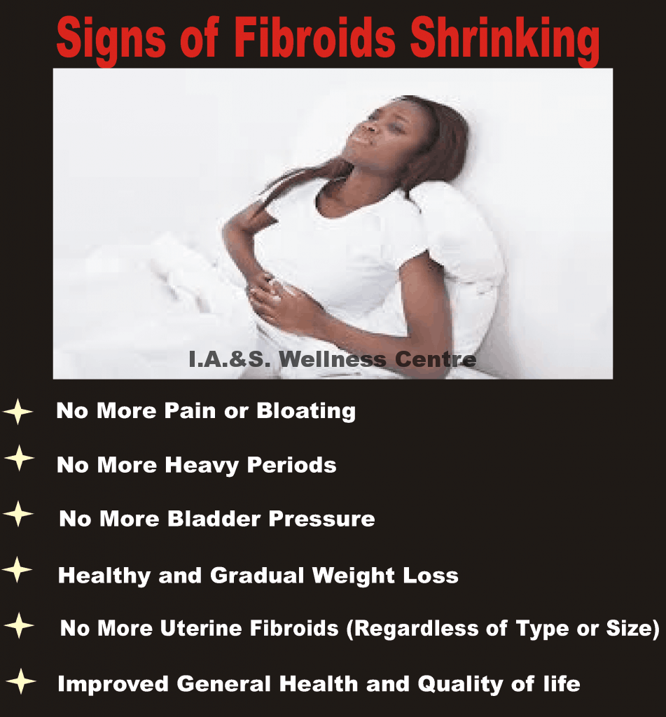 What are the signs of fibroids shrinking?