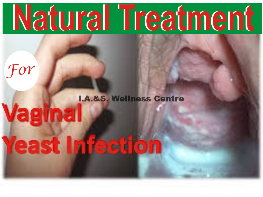 ALL YOU NEED TO KNOW ABOUT VAGINAL YEAST INFECTION AND IT’S NATURAL TREATMENT IN NIGERIA