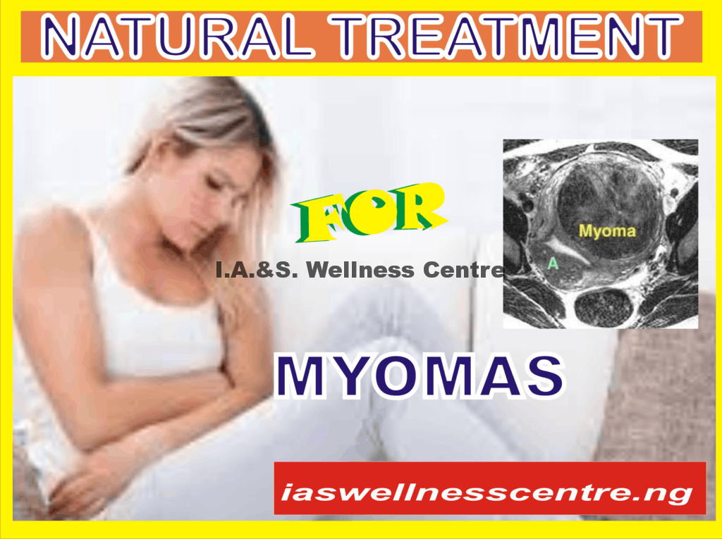 MYOMAS AND IT’S NATURAL TREATMENT IN NIGERIA