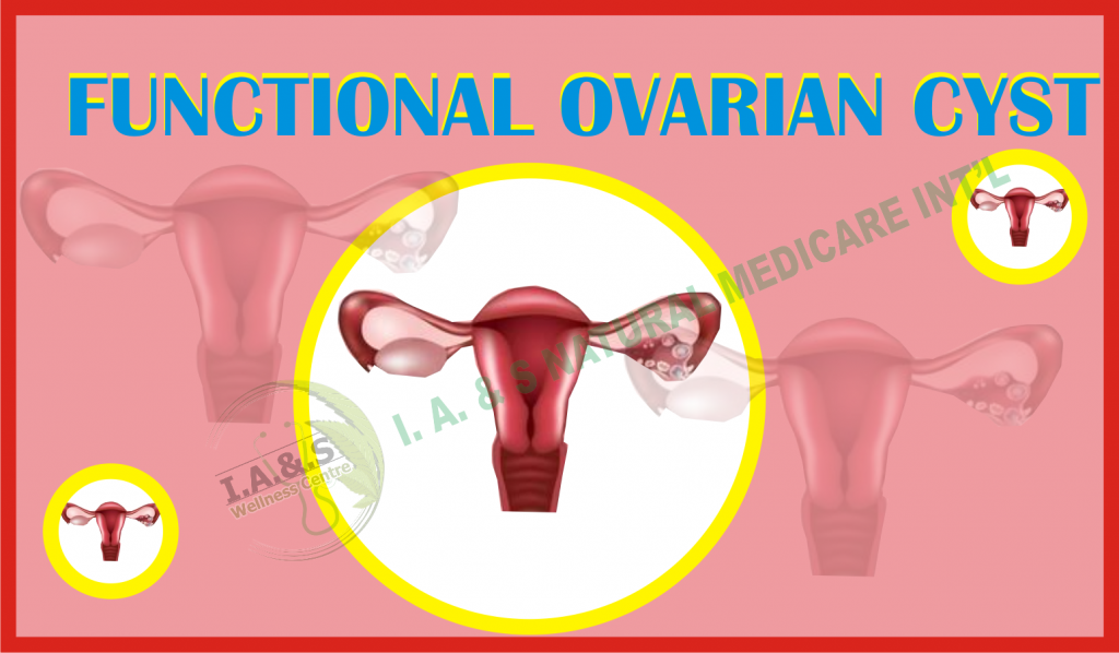 FUNCTIONAL OVARIAN CYSTS
