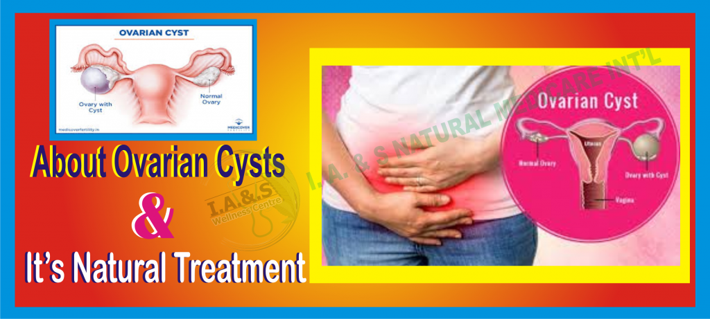 ABOUT OVARIAN CYSTS AND IT'S NATURAL TREATMENT
