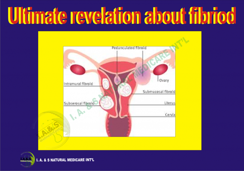 ULTIMATE REVELATION ABOUT FIBROIDS