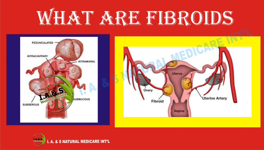WHAT ARE FIBROIDS