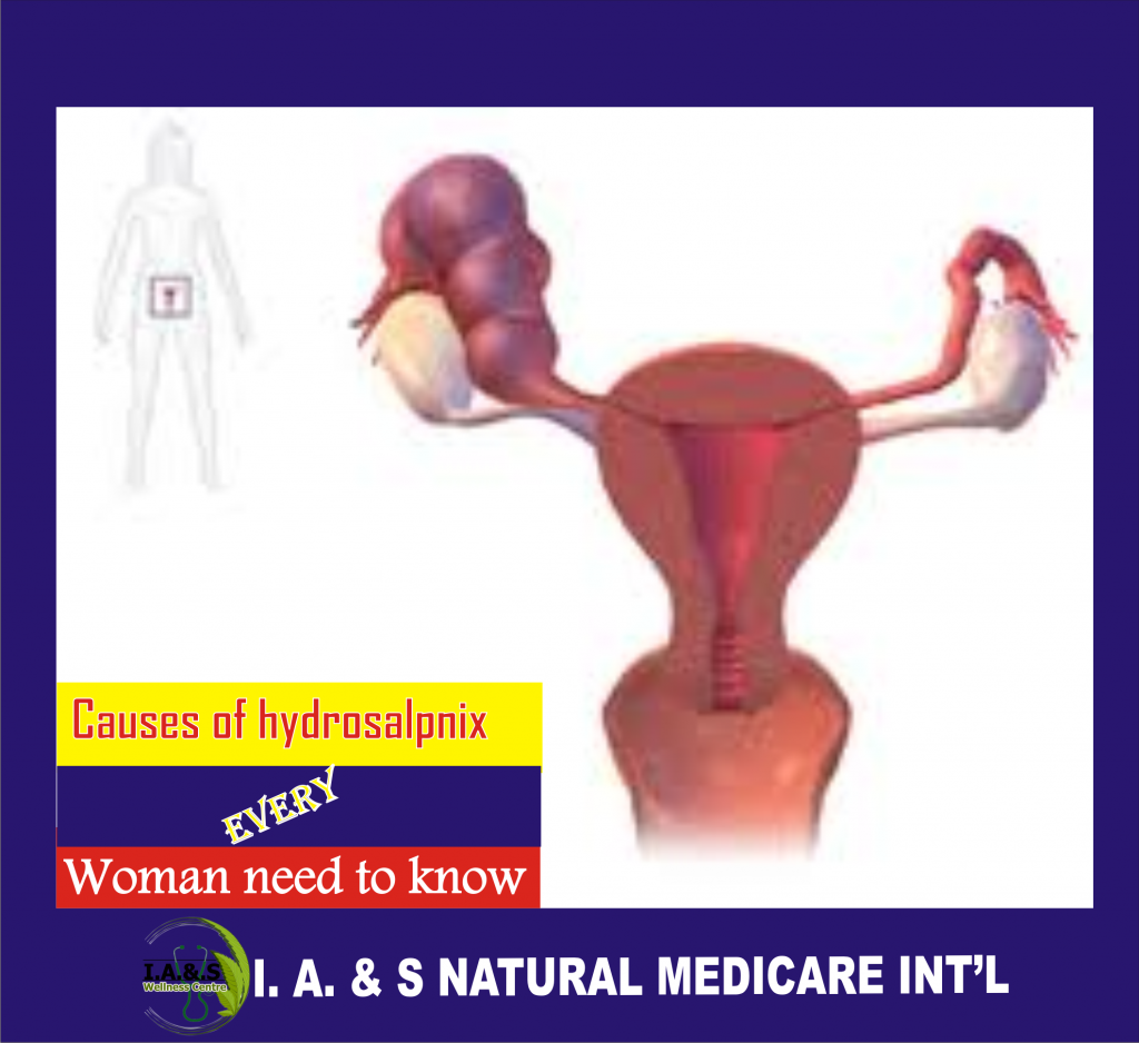 CAUSES OF HYDROSALPINX EVERY WOMAN NEED TO KNOW